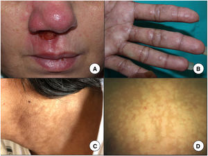 A, Mucocutaneous leishmaniasis manifests as a chronic ulcer often affecting the nasal mucosa. B, Firm cutaneous leishmaniasis papules on the palm of a patient coinfected with visceral leishmaniasis and human immunodeficiency virus. C, Hyperpigmented macules in the neck area. D, Hypopigmented macules as a manifestation of post-kala-azar dermal leishmaniasis in a 7-year-old boy. The diagnosis was established by molecular techniques, as the biopsy was negative.