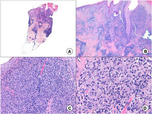 A, Panoramic punch biopsy of an erythematous nodule on the forearm (hematoxylin-eosin, original magnification ×5). B, Dense superficial dermal inflammatory infiltrate and pseudoepitheliomatous hyperplasia (hematoxylin-eosin, original magnification ×10). C, Detail of inflammatory infiltrate composed mainly of macrophages, lymphocytes, and some epithelioid cells (hematoxylin-eosin, original magnification ×20). D, Characteristic amastigotes in infected macrophages (hematoxylin-eosin, original magnification ×40).