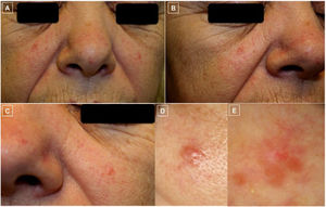 A-D, Clinical photographs. A-C, Clearly demarcated erythematous papules and disperse telangiectases on both cheeks and the tip of the nose. D, The largest papule, located on the left cheek was biopsied. E, Dermoscopic photograph corresponding to the previous lesion, showing, at the top, branching linear vessels on an unstructured salmon-colored area and the occasional whiteish region.