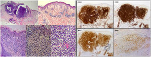 Histopathologic and immunohistochemical findings of the skin biopsy. On the left, hematoxylin–eosin (H-E) staining with images from smallest to largest magnification under an optical microscope, showing the histological characteristics of cutaneous follicle center B-cell lymphoma: lymphocyte infiltrate located in the middle and deep dermis with a mixed (nodular/diffuse) growth pattern and presence of cells of centrocytic and centroblastic appearance. On the right, immune-staining panel compatible with primary cutaneous center follicle lymphoma. The panel shows positive staining for CD10, CD20, Bcl-2, and Bcl-6 (hematoxylin–eosin, x2, x4, x10, x20, x20; IHQ, x2, x2, x2, x4).