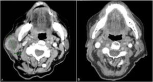 Computed tomography image of the tumor on the right side of the jaw before (A) and after (B) 4 cycles of pembrolizumab.