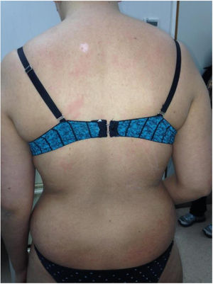 Clinical manifestations of acute graft-vs-host disease, with erythematous, round, shiny papules and plaques on the torso and arms.