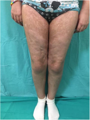 Clinical manifestations of sclerodermiform chronic graft-vs-host disease, with abnormal pigmentation and embossed appearance of the skin in the lower limbs.