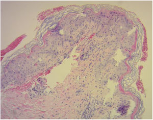aGVHD: Necrotic keratinocytes in the epidermis and satellitosis, vacuolization of the basement layer, dermal-epidermal detachment (hematoxylin–eosin, ×10).