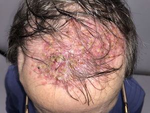 Wide scarring alopecia area on the scalp with perifollicular pustules and crusts.