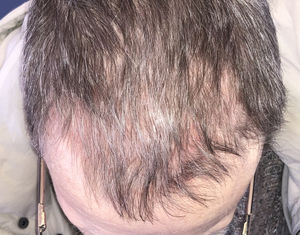 Complete healing after treatment.