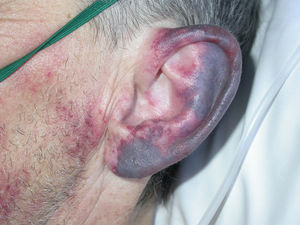 Purplish lesion on the outer ear.