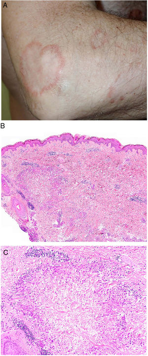 A, Granuloma annulare. An arm showing several erythematous annular plaques with a slightly raised border and clear center. B, Skin showing 2 areas of collagen degeneration and interstitial changes in the reticular dermis surrounded by a band-like inflammatory infiltrate. The superficial dermis and epidermis are preserved. Note also the perivascular lymphocytic crowns and diffuse increase in fibroblast density (hematoxylin-eosin, original magnification ×40). C, Note the central area of disordered collagen accompanied by acid mucin deposits and surrounded by an infiltrate of macrophages, palisading epithelioid cells, fibroblasts, lymphocytes, and occasional eosinophils. Dense perivascular lymphocytic crowns without vasculitis are visible (hematoxylin-eosin, original magnification ×200).