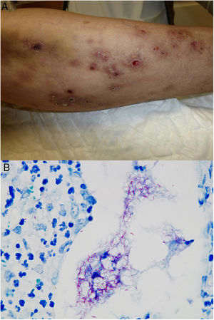 Example of Mycobacterium chelonae infection. A, Painful, suppurative nodular lesions with superficial ulcers and crusting (photo courtesy of Dr Rodríguez Blanco). B, M chelonae infection. Microorganisms sometimes tend to form clusters in areas of suppuration, where they can be demonstrated by Ziehl-Neelsen staining (Ziehl-Neelsen, original magnification ×1000).