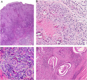 A, Chronic form of leishmaniasis. Confluent, poorly defined, epithelioid granulomas with a disordered appearance (messy granulomas)48 that usually occupy the full thickness of the dermis (hematoxylin-eosin, original magnification ×20). B, Vulvar bilharziasis cutanea tarda. Area of the reticular dermis showing an epithelioid granuloma with central necrosis around 7 round or oval structures. One of these, the most intact, has a lateral spicule, which is characteristic of Schistosoma hematobium. C, Swimmer’s itch due to cercariae. This is not a granulomatous reaction. Note the 3 longitudinal fragments of cercariae (species not identifiable) close to the eccrine glands and surrounded by a lymphohistiocytic infiltrate with numerous eosinophils. D, Onchocercoma. Note the granulomatous infiltrate with neutrophils and sclerosis, as well as several giant foreign body cells around the cross section in 3 areas. Note also the characteristic retraction artifact around the thick eosinophilic cuticle of the 3 filariae.