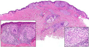 Leprosy. Image of tuberculoid leprosy specimen from the patient in Fig. 20A showing a “sausage-shaped” lymphohistiocytic infiltrate along the course of the neurovascular bundles (H&E, original magnification ×20). The lower left inset shows epithelioid granulomas surrounded by lymphocytes (H&E, original magnification ×100). The lower right inset shows a nerve in the center of the granuloma (H&E, original magnification ×100). H&E indicates hematoxylin-eosin.