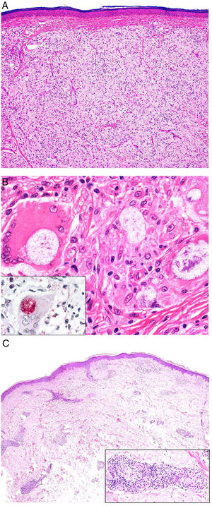 A, Lepromatous leprosy. Image showing a sheetlike histiocytic infiltrate under a Grenz zone (H&E, original magnification ×40). B, Higher magnification view showing numerous foamy histiocytes and multinucleated giant cells with globi in their cytoplasms (H&E, original magnification ×200). The lower left inset shows numerous bacilli stained using the Job-Fite technique; some of these are grouped into globi in the macrophages (Job-Fite, original magnification ×200). C, Dimorphic leprosy. Biopsy specimen from the patient in Fig. 19B, with a superficial and deep perivascular and periadnexal inflammatory infiltrate (H&E, original magnification ×20), composed of lymphocytes and histiocytes, as shown in the lower right inset. H&E indicates hematoxylin-eosin.