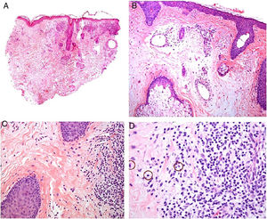 Morbihan disease. A, Panoramic image showing dermal edema with a perifollicular and interstitial inflammatory infiltrate (H&E, original magnification ×20). B, Detail of pronounced dermal edema together with dilated vessels (H&E, original magnification ×100). C, Perivascular lymphohistiocytic infiltrates (H&E, original magnification ×200). D, Detail of several polymorphonuclear neutrophils in the infiltrate (H&E, original magnification ×400). H&E indicates hematoxylin-eosin.
