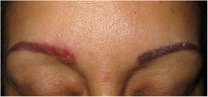 Sarcoidosis. Erythematous papules on both eyebrows after a tattoo (photo courtesy of Dr JF Mir-Bonafé).