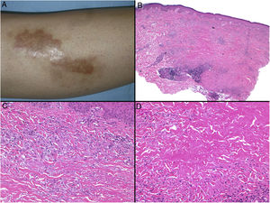 Necrobiosis lipoidica. A, Erythematous-yellowish infiltrative plaque with a wax-like appearance. The center of the plaque is paler and has an atrophic appearance. B, Panoramic view showing a focal inflammatory infiltrate arranged in layers that are more or less parallel to the epidermis, together with areas of thickened, intensely eosinophilic collagen. Note the periadnexal lymphoid aggregates in the deep part of the biopsy specimen (deep dermis) (H&E, original magnification x40). C, Higher-magnification view showing an interstitial granulomatous inflammatory infiltrate arranged between bundles of thickened, degenerated collagen. Several multinucleated histiocytes are also visible (H&E, original magnification x200). D, High-magnification view of the other part of the biopsy specimen showing a palisaded granuloma centered by an area of clearly degenerated collagen (H&E, original magnification x400). H&E indicates hematoxylin-eosin.