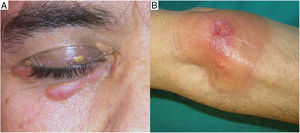 Clinical appearance of necrobiotic xanthogranuloma. A, Hallmark clinical presentation of necrobiotic xanthogranuloma featuring erythematous-yellow papules and plaques on the eyelid. B, Extracutaneous location in the form of an ulcerated yellow-orange plaque.