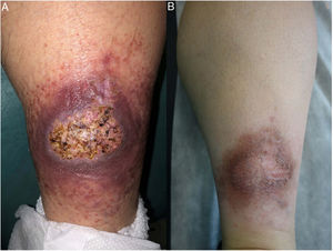Crohn disease. Erythematous, ulcerated, infiltrative plaque measuring 6 cm on the calf of a patient with Crohn disease (A); this improved over 6 months to form an erythematous, hyperpigmented, infiltrative plaque (B).