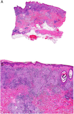 Crohn disease. A, Granulomatous dermatitis with multiple granulomas in the reticular dermis, with sparing of the epidermis and papillary dermis (H&E, original magnification x20). B, The granulomas are similar to those seen in the digestive tract: noncaseating with multinucleated giant cells and possibly a dense lymphocytic infiltrate (H&E, original magnification x40). H&E indicates hematoxylin-eosin.