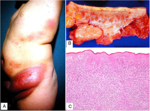 Granulomatous slack skin. A, Erythematous, infiltrative skin masses at the waist of an 11-year-old boy. B, Surgical specimen with dermal-hypodermal thickening. C, Diffuse lymphoid infiltrate in the dermis (hematoxylin-eosin, original magnification x40).
