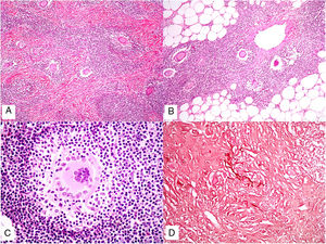 Granulomatous slack skin. A, Lymphoid infiltrate in the dermis with numerous scattered multinucleated giant cells (H&E, original magnification x40). B, Lymphoid infiltrate in the septae of the subcutaneous tissue with multinucleated giant cells (H&E, original magnification x40). C, Detail of a giant cell with lymphophagocytosis (H&E, original magnification x200). D, Fragmentation and loss of elastic fibers (orcein x100). H&E indicates hematoxylin-eosin.
