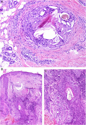 A, Central centrifugal cicatricial alopecia. Foreign body granuloma formed in response to hair shaft fragments and keratin lamellae (H&E, original magnification x100). B and C, Folliculitis decalvans. Foreign body granulomatous reactions to hair shaft fragments may be observed in advanced stages (H&E, original magnification x20 [B] and x100 [C]). H&E indicates hematoxylin-eosin.