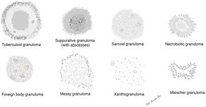 Schematic representation of the main types of granulomas.