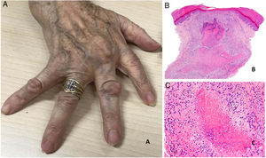 A, Rheumatoid arthritis. Clinical appearance of 2 rheumatoid nodules near the interphalangeal joints of the hands. Note the smooth, whitish surface without signs of inflammation. B, Rheumatoid arthritis. Panoramic histologic view of a rheumatoid nodule, which has reached superficial areas of the dermis and extended into the deep tissues. Note the palisaded granuloma with an intensely eosinophilic necrotic center (H&E, original magnification x20). C, Rheumatoid arthritis. Histologic detail of palisaded granuloma forming the base of the rheumatoid nodule. Note the layer of palisading histiocytes around an intensely eosinophilic center of fibrinoid necrosis (H&E, original magnification x200). H&E indicates hematoxylin-eosin.