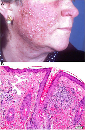 Rosacea. A, Papules, pustules, and cystic nodules on the face. B, Rosacea. Perifollicular granuloma with superficial dermal telangiectasias (hematoxylin-eosin, original magnification x100).