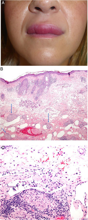 A, Granulomatous cheilitis. Marked swelling of the upper lip. B, Granulomatous cheilitis. Marked swelling of the dermis of the lip, vascular ectasia, mild lymphocytic infiltration, and perivascular and intravascular granulomas (arrows) (H&E, original magnification x40). C, Granulomatous cheilitis. Dilated lymph vessel with intravascular histiocytic aggregates and a perivascular granuloma (H&E, original magnification x200). H&E indicates hematoxylin-eosin.