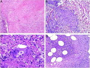 A, Tuberculoid granuloma. Central areas of caseous necrosis surrounded by epithelioid histiocytes and an evident Langhans-type giant cell. Note the peripheral crown of lymphocytes (H&E, original magnification x100). B, Sarcoid granuloma. Non-necrotizing epithelioid granuloma without a prominent crown of lymphocytes (naked) (H&E, original magnification x100). C, Intracytoplasmic asteroid body with a star-like shape that is characteristic but not pathognomonic of sarcoid granuloma (H&E, original magnification x400). D, Suppurative granuloma (with abscesses) associated with atypical mycobacterial disease. Epithelioid histiocytes around a center of polymorphonuclear neutrophils (H&E, original magnification x100). H&E indicates hematoxylin-eosin.