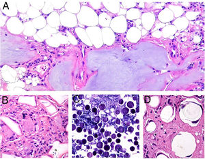 Granulomas associated with dermal fillers. A, The bluish material with a myxoid or mucinous appearance is hyaluronic acid. It is interspersed with histiocytes containing variably sized vacuoles (arrows) corresponding to previously injected silicone (H&E, original magnification x200). B, Granulomatous reaction containing polygonal acrylic methacrylate hydrogel structures (H&E, original magnification x400). C, Reaction to hyaluronic acid and dextran compound (H&E, original magnification x400). D, Polymethylmethacrylate spheres in bovine collagen (H&E, original magnification x400). H&E indicates hematoxylin-eosin. H&E indicates hematoxylin-eosin.
