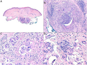 Granulomatous reaction to suture material. A, Panoramic view of surgical specimen showing 2 deep granulomas (H&E, original magnification x40). B, Detail showing a mixed inflammatory infiltrate with lymphocytes, macrophages, epithelioid histiocytes, and several multinucleated foreign giant cells around suture filaments (H&E, original magnification x200). C) Multinucleated foreign body giant cells may sometimes be the predominant cell type (H&E, original magnification x400). D, Mutinucleated giant cells digesting suture fibers (H&E, original magnification x1000). H&E indicates hematoxylin-eosin.