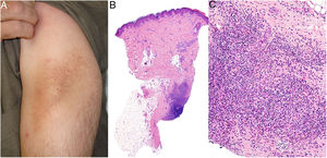 Aluminum granuloma. A, Subcutaneous nodule with lichenification caused by scratching at vaccination site in a patient undergoing allergy desensitization. B, Infiltrate mainly occupying the hypodermis (H&E, original magnification x20). Granulomas consisting of lymphocytes, histiocytes, and eosinophils (H&E, original magnification x200). H&E indicates hematoxylin-eosin.