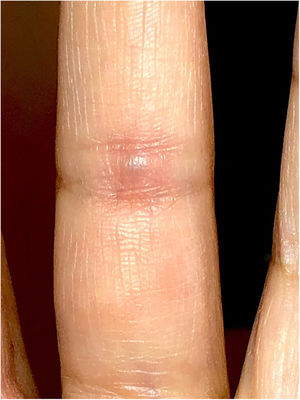 Bluish-violet nodule on the palmar side of the digit.