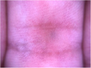 Dermoscopic examination: blue structureless pattern.