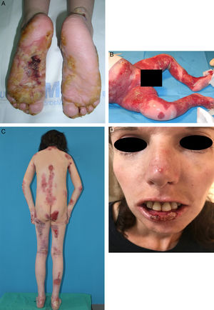 Clinical signs of the main types of EB. A, EB simplex. B, junctional EB. C, dystrophic EB. D, Kindler syndrome. EB refers to epidermolysis bullosa.