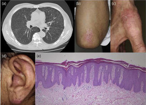 Examination by lung computed tomography revealed lymph node adenopathy.