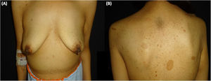 Clinical presentation. A, Abdominal deformity caused by a mass on the right flank. B, Multiple freckles and several café au lait spots and neurofibromas on the trunk.