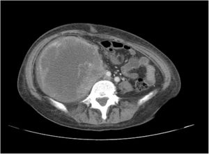 Radiologic image. Computed tomography scan of the abdomen showing a large right retroperitoneal mass with a diameter of 11 cm displacing adjacent structures.