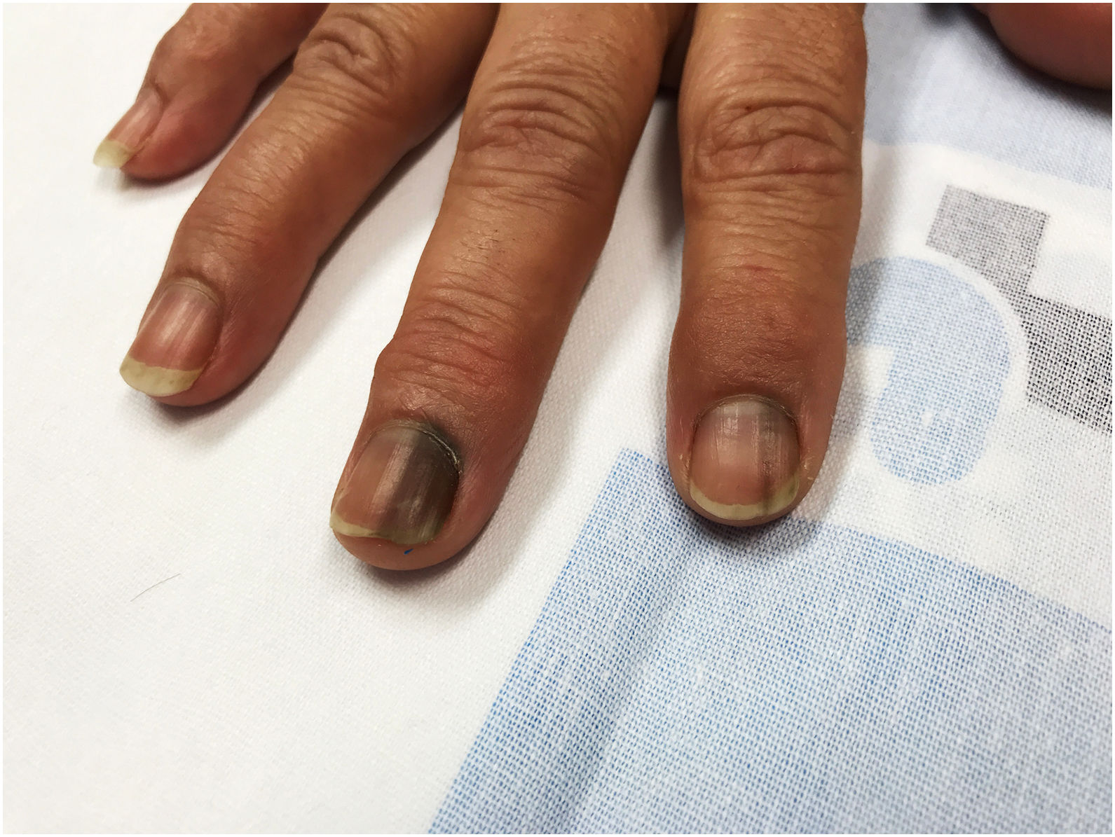 What Explains This Man's Nail Discoloration? | Consultant360