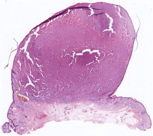 Well-defined dermal tumor with a polypoid appearance (hematoxylin–eosin).
