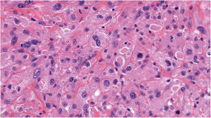 Large cells with abundant eosinophilic cytoplasm containing granules, nuclear pleomorphism, and some mitotic forms (hematoxylin–eosin, original magnification ×40).