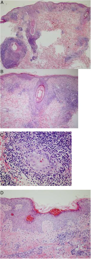 Histopathology of one of the lesions. A and B, Dense inflammatory infiltrate in the epidermis and pilosebaceous follicles. C, Infiltrate composed mainly of lymphocytes and histiocytes, with few plasma cells. D, Areas of epidermal atrophy, parakeratosis, and thickening of the basement membrane, alternating with other areas in which the architecture is better preserved.