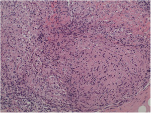 Histologic study of the facial skin lesions with granulomas in the middle and deep dermis, with no central necrosis or lymphocytic corona.