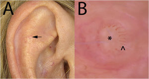 A, Clinical presentation of the lesion on the right antihelix. B, Dermoscopic image of the lesion using contact dermoscopy and 60× magnification (image acquisition was very difficult given the very small size of the lesion). Slightly whiteish central area without structure (*) and radially distributed hairpin vessels (^).