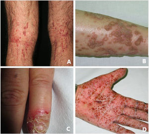 Typical clinical appearance of autoinflammatory keratinization disease. A, Keratosis lichenoides chronica. B, Porokeratosis. C, Acrodermatitis continua of Hallopeau. D, Pustular psoriasis.