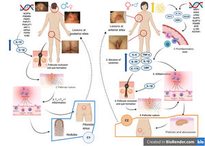 Model of the 2 endotypes of hidradenitis suppurativa (HS) and their association with the pathogenesis of autoinflammatory keratinization disease (AiKD). The follicular endotype (cluster C1) is affected by male predominance, follicular occlusion tetrad and/or acne vulgaris, follicular-comedone-like lesions that progress to inflammatory nodules, with fewer abscesses, sinus tracts, and hypertrophic scars. Furthermore, the genetic burden is greater, with the presence of mutations in the Notch/γ-secretase signaling pathway. However, while they present elevated inflammatory parameters, such as serum TNF-α and C-reactive protein, they do so to a lesser extent than those of the C2 cluster. The lesion mainly affects the posterior areas of the body. The inflammatory endotype, or C2 cluster, is more common in women, mainly in those who have obesity or overweight. A family history of HS is not as closely associated with this group, although mutations in MEFV and NLRP3 that promote inflammation have been reported. Higher levels of systemic inflammation have been reported in the TH17 response (TNF-α, IL-12, IL-23, and IL-17). The most typical lesions are sinus tracts and scars, especially on the anterior areas of the body. In the inflammatory endotype, autoinflammation precedes keratinization and is thus defined as an AiKD sensu stricto. In the follicular endotype, pathogenesis begins through an alteration of keratinization that consequently leads to autoinflammation.