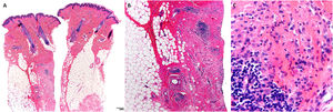 Skin biopsy from one of the case reports. A, Normal epidermis, with lesions mainly in the dermis and subcutaneous cellular tissue (hematoxylin-eosin, ×4). B, Areas of sclerosis, together with follicular lymphoid hyperplasia and histiocytic infiltrate (hematoxylin-eosin, ×4). C, Histiocytes with granular cytoplasm (hematoxylin-eosin, ×20).