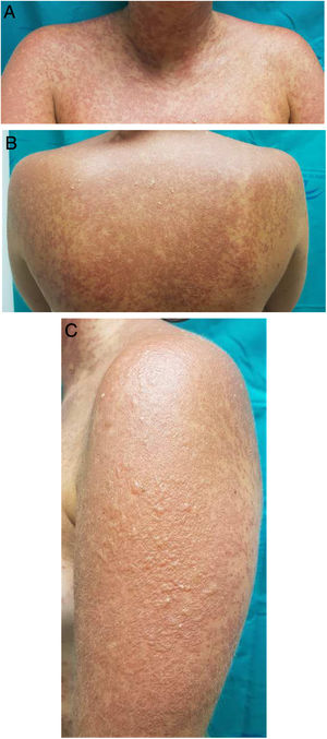 A, Erythematous-violaceous maculopapular rash on the anterior trunk and neck. B, Erythematous-violaceous maculopapular rash on the posterior trunk with solitary bullous formations. C, Skin at 48 hours after onset of the rash, with formation of blisters.