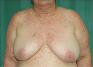 Confluent erythematous papules on the neck, shoulders, and chest.